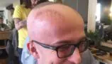 Tom shaving his head during radiotherapy