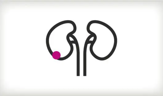 Icon representing Wilms' tumour