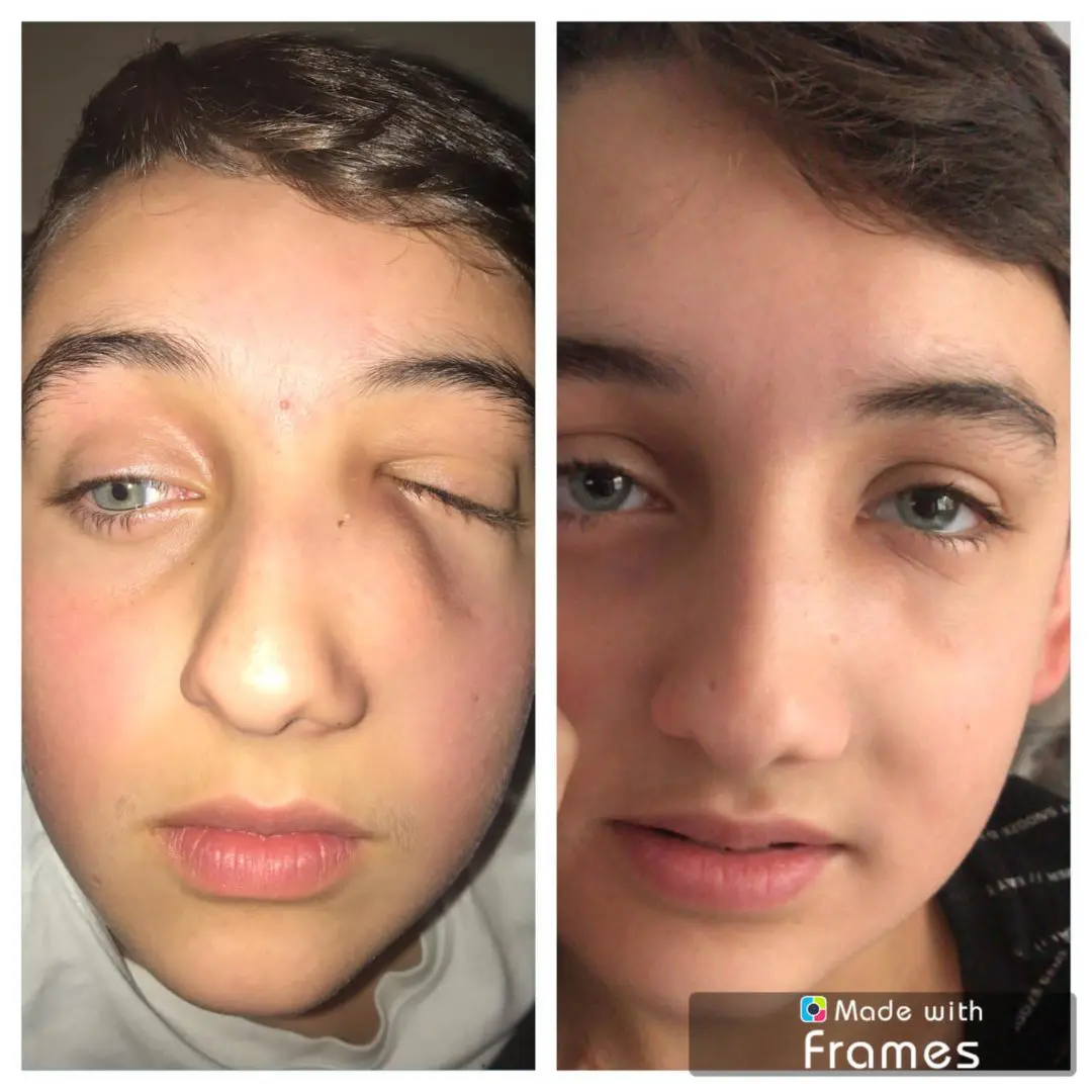 Before and after: The tumour on Fionn's face